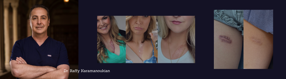 keloid before and after los angeles plastic surgery