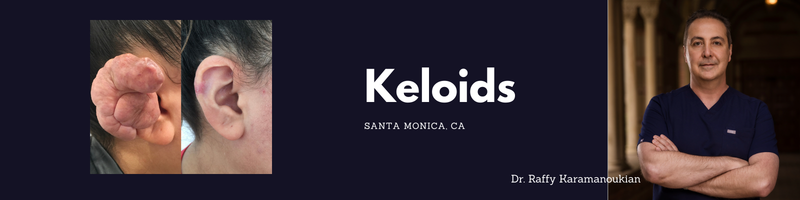 removing scars and keloids in beverly hills and santa monica