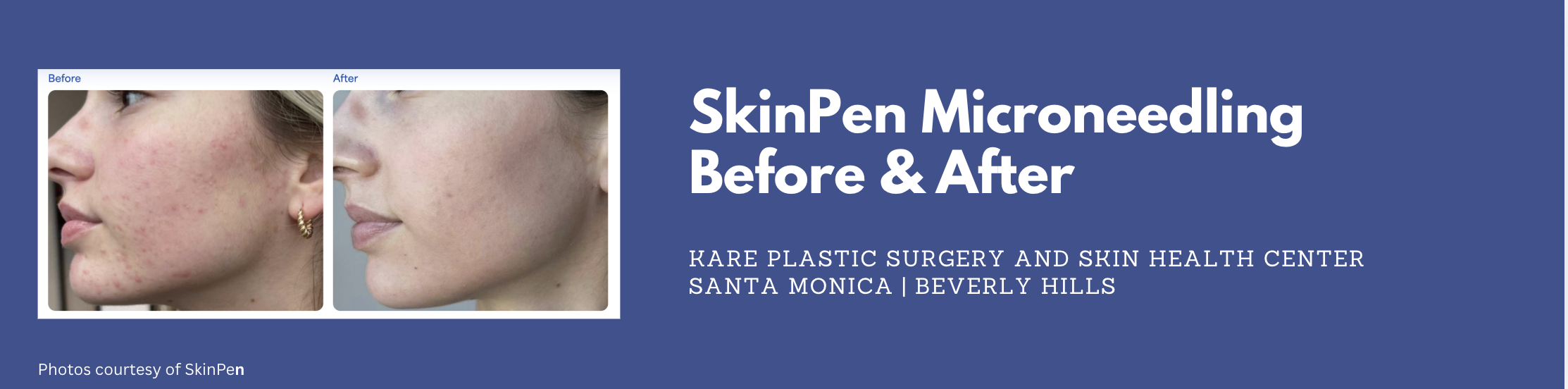 microneedling in santa monica with doctor karamanoukian