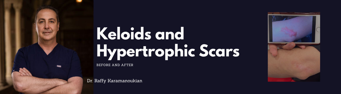 keloid scar revision before and after los angeles dr. karamanoukian