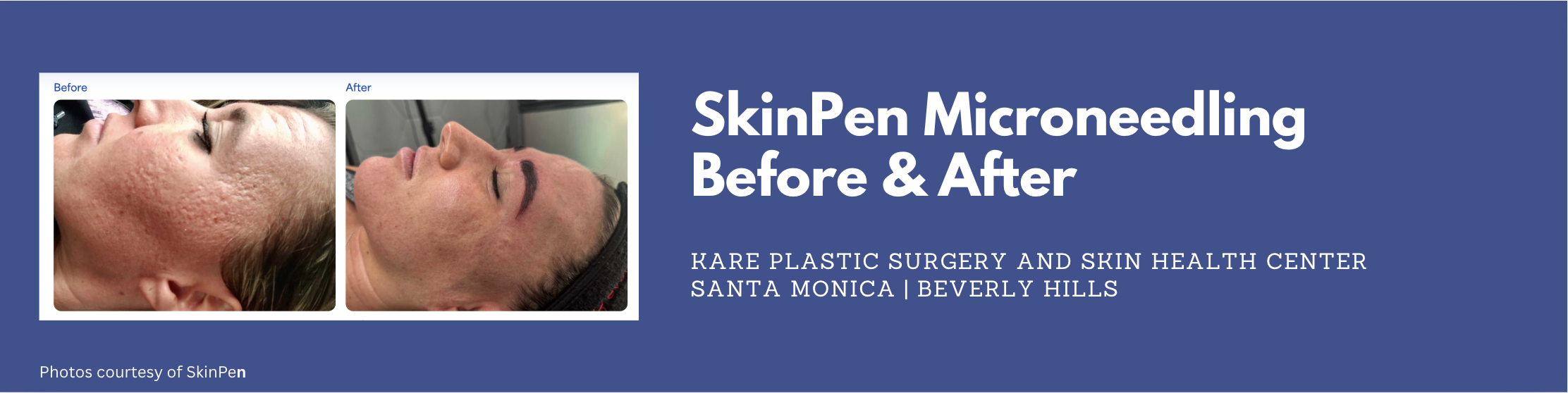 skinpen microneedling with exosomes and PRP in santa monica