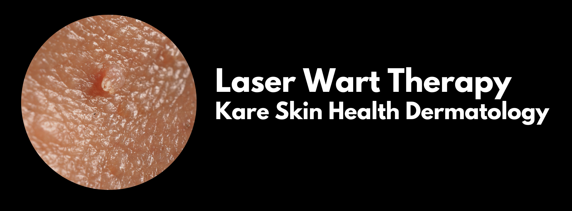 laser wart treatment in los angeles at kare in santa monica dermatology