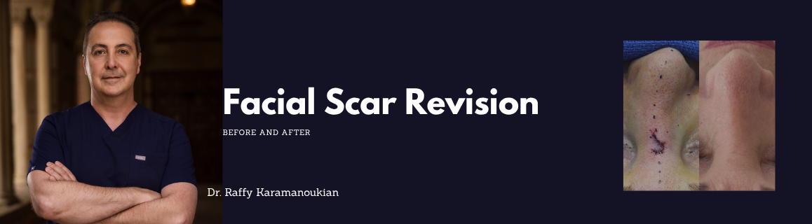 before and after facial scar revision dr. raffy karamanoukian