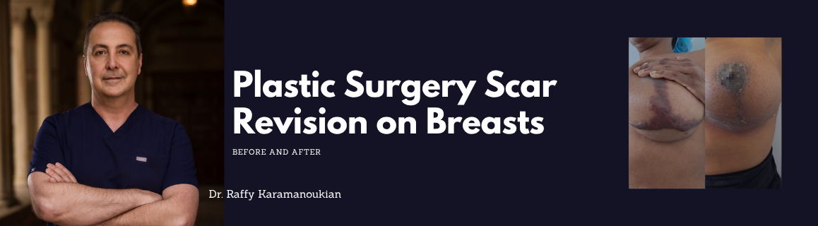 breast implant before and after plastic surgery scar revision los angeles