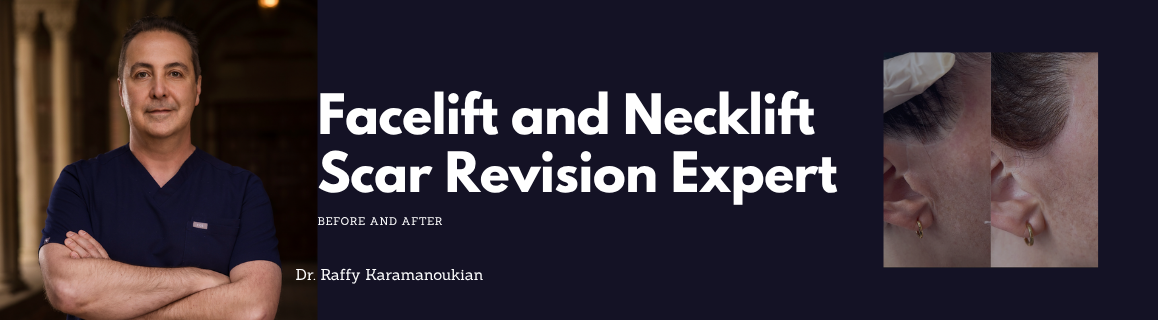 facelift and necklift scar revision los angeles dr. raffy karamanoukian